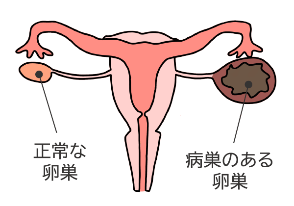 子宮内膜症と卵巣の「がん化」との関連