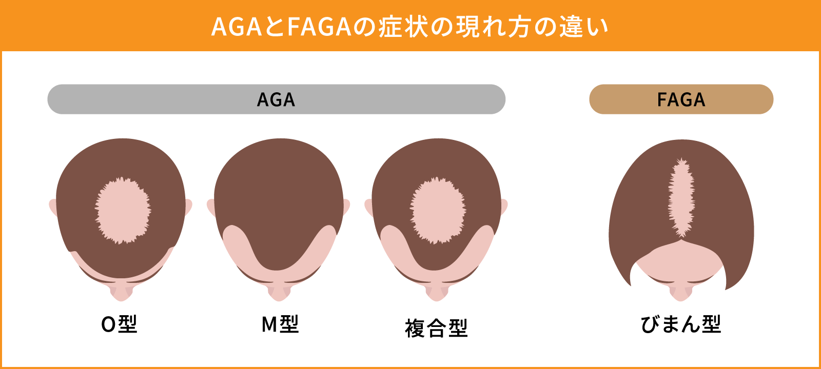 AGAとFAGAの症状の現れ方の違い