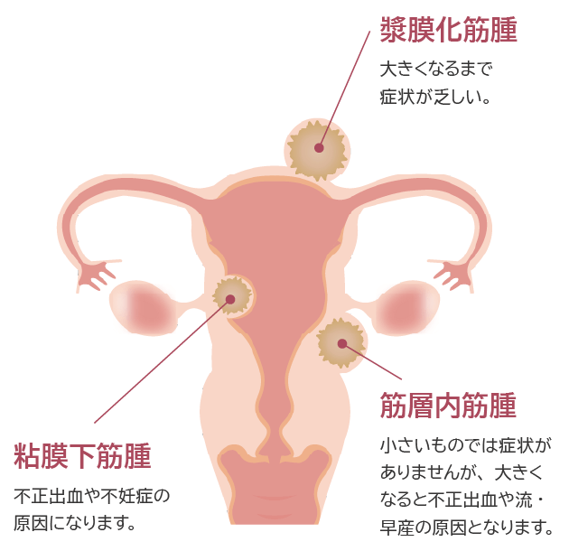 子宮筋腫とは