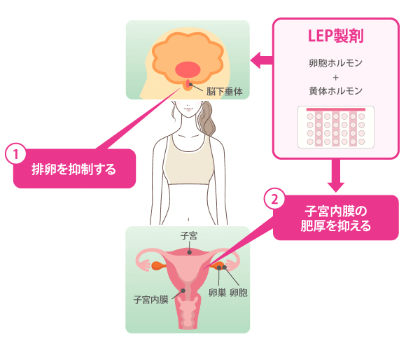 子宮内膜症と卵巣の「がん化」との関連