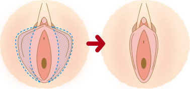 小陰唇を小さくしたい