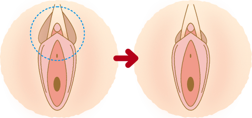 小陰唇と大陰唇の間にヒダがある