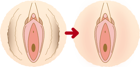 大陰唇がたるんでいる