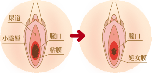 処女膜を復元させたい