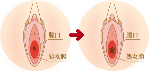 処女膜を切開・切除したい