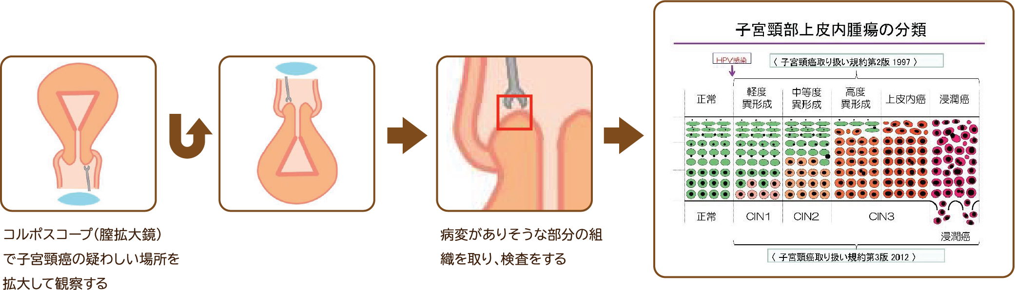 高リスクHPV（ハイリスク型HPV）